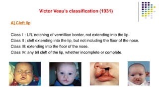 Victor Veau’s classification (1931)
A] Cleft lip
Class I : U/L notching of vermillion border, not extending into the lip.
Class II : cleft extending into the lip, but not including the floor of the nose.
Class III: extending into the floor of the nose.
Class IV: any b/l cleft of the lip, whether incomplete or complete.
34
 