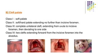 B] Cleft palate
Class I : soft palate
Class II : soft/hard palate extending no further than incisive foramen.
Class III: complete unilateral cleft, extending from uvula to incisive
foramen, then deviating to one side
Class IV: two clefts extending forward from the incisive foramen into the
alveolus.
 