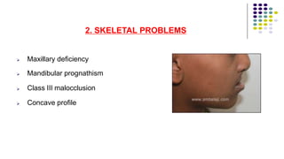 2. SKELETAL PROBLEMS




Maxillary deficiency
Mandibular prognathism
Class III malocclusion
Concave profile
 