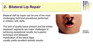 Bilateral cleft lip repair can be one of the most
challenging technical procedures performed
in children with clefts.
The lack of quality tissue present and the widely
displaced segments are major challenges to
achieving exceptional results, but superior
technique and adequate
mobilization of the tissue flaps
usually yields excellent esthetic results.
2- Bilateral Lip Repair
 