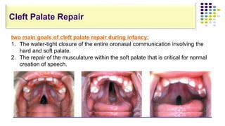 two main goals of cleft palate repair during infancy:
1. The water-tight closure of the entire oronasal communication involving the
hard and soft palate.
2. The repair of the musculature within the soft palate that is critical for normal
creation of speech.
Cleft Palate Repair
 