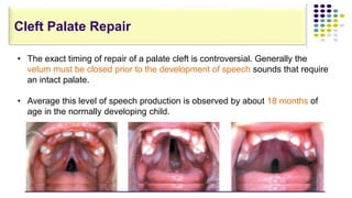 • The exact timing of repair of a palate cleft is controversial. Generally the
velum must be closed prior to the development of speech sounds that require
an intact palate.
• Average this level of speech production is observed by about 18 months of
age in the normally developing child.
Cleft Palate Repair
 