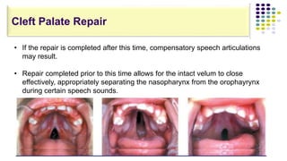 • If the repair is completed after this time, compensatory speech articulations
may result.
• Repair completed prior to this time allows for the intact velum to close
effectively, appropriately separating the nasopharynx from the orophayrynx
during certain speech sounds.
Cleft Palate Repair
 