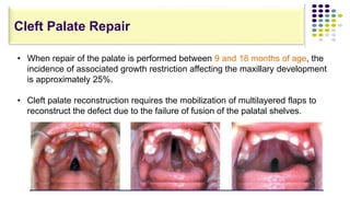 • When repair of the palate is performed between 9 and 18 months of age, the
incidence of associated growth restriction affecting the maxillary development
is approximately 25%.
• Cleft palate reconstruction requires the mobilization of multilayered flaps to
reconstruct the defect due to the failure of fusion of the palatal shelves.
Cleft Palate Repair
 