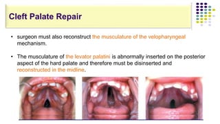 • surgeon must also reconstruct the musculature of the velopharyngeal
mechanism.
• The musculature of the levator palatini is abnormally inserted on the posterior
aspect of the hard palate and therefore must be disinserted and
reconstructed in the midline.
Cleft Palate Repair
 