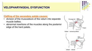 Clefting of the secondary palate causes:
• division of the musculature of the velum into separate
muscle bellies.
• abnormal insertions of the muscles along the posterior
edge of the hard palate.
VELOPHARYNGEAL DYSFUNCTION
 