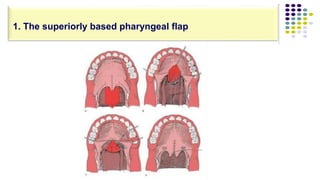 1. The superiorly based pharyngeal flap
 