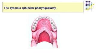 The dynamic sphincter pharyngoplasty
 
