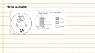 Pfeiffer classification
 