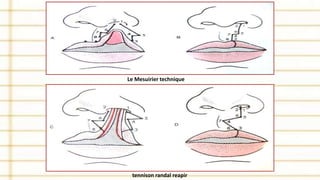 Le Mesuirier technique
tennison randal reapir
 