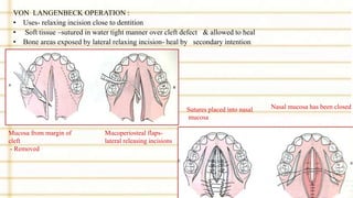 VON LANGENBECK OPERATION :
• Uses- relaxing incision close to dentition
• Soft tissue –sutured in water tight manner over cleft defect & allowed to heal
• Bone areas exposed by lateral relaxing incision- heal by secondary intention
Mucosa from margin of
cleft
- Removed
Mucoperiosteal flaps-
lateral releasing incisions
Sutures placed into nasal
mucosa
Nasal mucosa has been closed
 