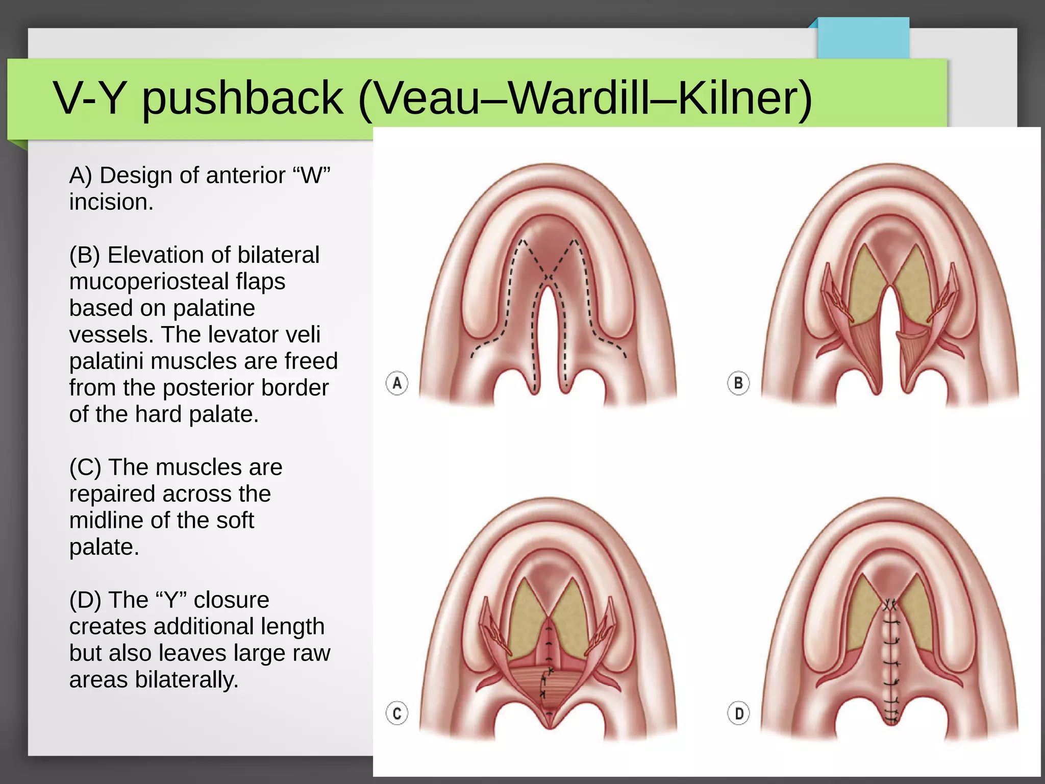 Cleft Lip and Palate | PDF