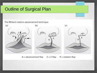 Cleft Lip and Palate | PDF