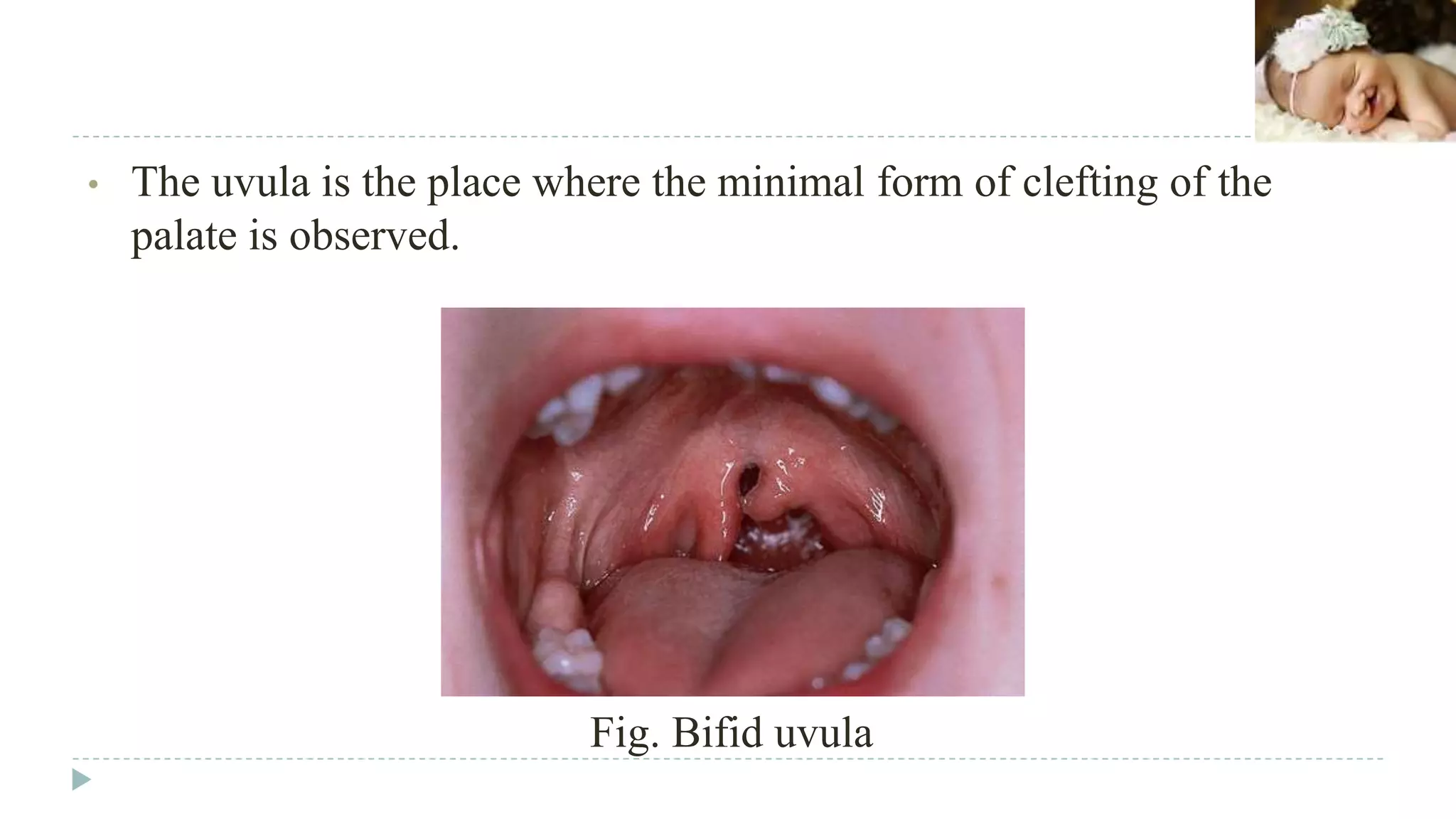 Normal Uvula Variations Cleft lip and palate | PPTX