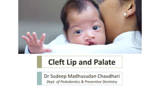 Cleft Lip and Palate
Dr Sudeep Madhusudan Chaudhari
Dept. of Pedodontics & Preventive Dentistry
 