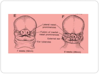 Cleft lip and palate ----- | PPTX