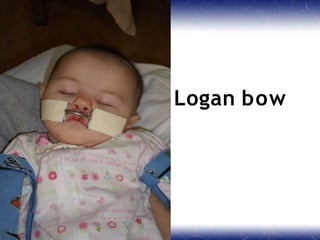Logan bow
 
