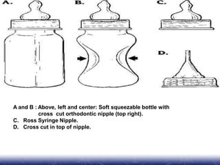 A and B : Above, left and center: Soft squeezable bottle with
cross cut orthodontic nipple (top right).
C. Ross Syringe Nipple.
D. Cross cut in top of nipple.
 