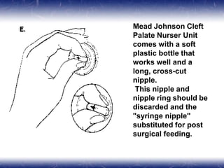 Mead Johnson Cleft
Palate Nurser Unit
comes with a soft
plastic bottle that
works well and a
long, cross-cut
nipple.
This nipple and
nipple ring should be
discarded and the
"syringe nipple"
substituted for post
surgical feeding.
 