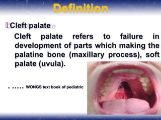 Definition
🞒 Cleft palate
Cleft palate refers to failure in
development of parts which making the
palatine bone (maxillary process), soft
palate (uvula).
. .…. WONGS text book of pediatric
 