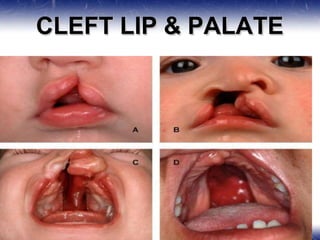 CLEFT LIP & PALATE
 