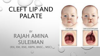 CLEFT LIP AND
PALATE
BY
RAJAH AMINA
SULEIMAN
(RN, RM, RNE, RBPN, BNSC., MSC)
 