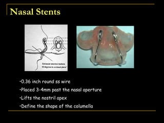 Nasal Stents
•0.36 inch round ss wire
•Placed 3-4mm past the nasal aperture
•Lifts the nostril apex
•Define the shape of the columella
 