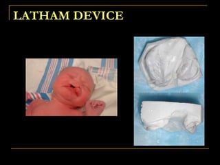 LATHAM DEVICE
 