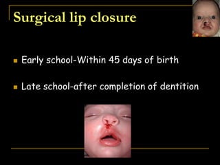 Surgical lip closure
 Early school-Within 45 days of birth
 Late school-after completion of dentition
 