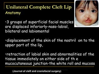 Unilateral Complete Cleft Lip
Anatomy
•3 groups of superficial facial muscles
are displaced inferiorly-naso-labial,
bilateral and labiomental
•displacement of the skin of the nostril on to the
upper part of the lip,
•retraction of labial skin and abnormalities of the
tissue immediately on either side of th e
mucocutaneous junction-the white roll and mucosa
Clinical Aspects of Cleft Lip/Palate Reconstruction
(Journal of cleft and craniofacial surgery)
 