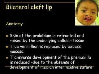 Bilateral cleft lip
Anatomy
 Skin of the prolabium is retracted and
raised by the underlying cellular tissue
 True vermillion is replaced by excess
mucosa
 Transverse development of the premaxilla
is reduced –due to the absense of
development of median interincisive suture
 