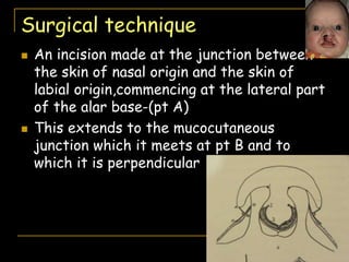 Surgical technique
 An incision made at the junction between
the skin of nasal origin and the skin of
labial origin,commencing at the lateral part
of the alar base-(pt A)
 This extends to the mucocutaneous
junction which it meets at pt B and to
which it is perpendicular
 