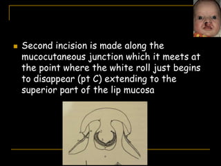  Second incision is made along the
mucocutaneous junction which it meets at
the point where the white roll just begins
to disappear (pt C) extending to the
superior part of the lip mucosa
 
