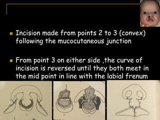  Incision made from points 2 to 3 (convex)
following the mucocutaneous junction
 From point 3 on either side ,the curve of
incision is reversed until they both meet in
the mid point in line with the labial frenum
 