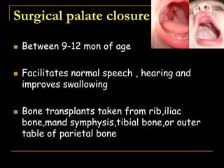 Surgical palate closure
 Between 9-12 mon of age
 Facilitates normal speech , hearing and
improves swallowing
 Bone transplants taken from rib,iliac
bone,mand symphysis,tibial bone,or outer
table of parietal bone
 
