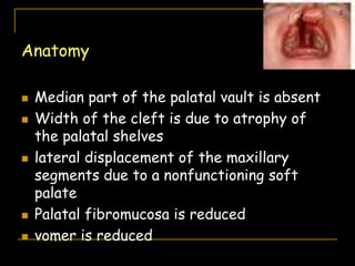 Anatomy
 Median part of the palatal vault is absent
 Width of the cleft is due to atrophy of
the palatal shelves
 lateral displacement of the maxillary
segments due to a nonfunctioning soft
palate
 Palatal fibromucosa is reduced
 vomer is reduced
 