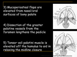 3) Mucoperiosteal flaps are
elevated from nasal/oral
surfaces of bony palate
4) Dissection of the greater
palatine vessels from the
foramen lengthens the pedicle
5) Tensor veli palatini muscle is
elevated off the hamulus to aid in
relaxing the midline closure
Clinical Aspects of Cleft Lip/Palate Reconstruction
 