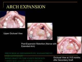 PRESURGICAL ORTHODONTIC MANAGEMENT
AND SECONDARY
BONE GRAFT IN THE CLEFT PATIENTS
*ABIDA IJAZ, sayeeED ASHRAF CHEEMA,
Upper Occlusal View
Post-Expansion Retention (Nance with
Extended Arm)
Occlusal View at 11/2 months
after Secondary Graft
ARCH EXPANSION
 