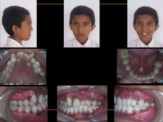 MOHAMMED AHMED
13/M
26404
PRE-TREATMENT
 