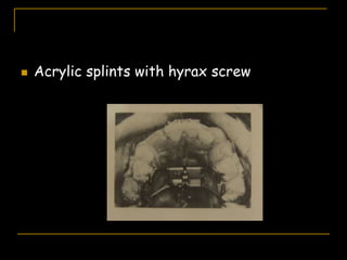  Acrylic splints with hyrax screw
 