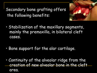 Secondary bone grafting offers
the following benefits:
• Stabilization of the maxillary segments,
mainly the premaxilla, in bilateral cleft
cases.
• Bone support for the alar cartilage.
• Continuity of the alveolar ridge from the
creation of new alveolar bone in the cleft
area.
 