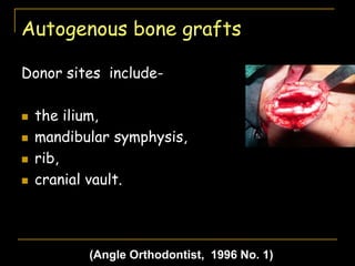 Autogenous bone grafts
Donor sites include-
 the ilium,
 mandibular symphysis,
 rib,
 cranial vault.
(Angle Orthodontist, 1996 No. 1)
 