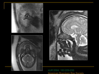 AJR 2004; 183:229-235
 