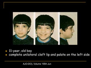  11-year, old boy
 complete unilateral cleft lip and palate on the left side
AJO-DO), Volume 1994 Jun
 