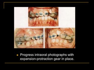 Progress intraoral photographs with
expansion-protraction gear in place.
 