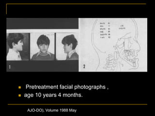  Pretreatment facial photographs ,
 age 10 years 4 months.
AJO-DO), Volume 1988 May
 