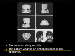  Pretreatment study models.
 The patient wearing an orthopedic face mask
appliance.
 
