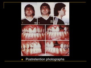  Postretention photographs
 