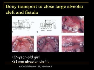 Bony transport to close large alveolar
cleft and fistula
AJO-DOVolume 127, Number 2
•17-year-old girl
•21 mm alveolar cleft.
 