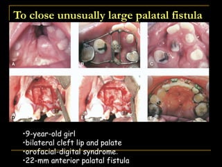 To close unusually large palatal fistula
•9-year-old girl
•bilateral cleft lip and palate
•orofacial-digital syndrome.
•22-mm anterior palatal fistula
 
